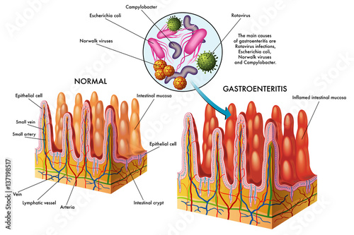 gastroenteritis