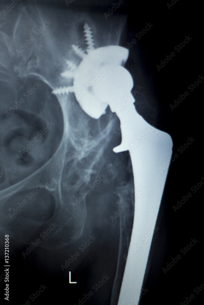 Hip replacement implant Xray scan Stock Photo | Adobe Stock