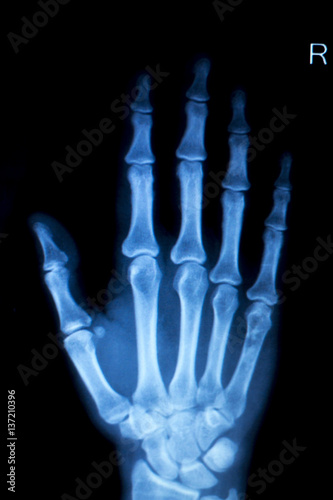 Hand fingers inury Xray scan © edwardolive