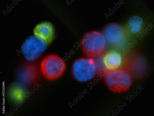 Microscopic image of circulating breast cancer cell cluster