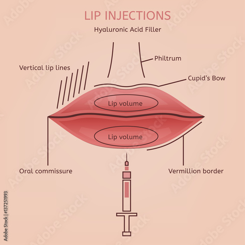 Lips Injections Image