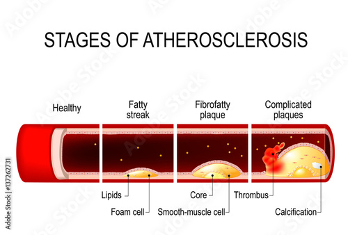 stages of atherosclerosis photo