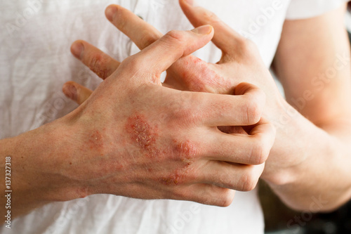 The problem with many people - eczema on hand. White background. Man itchind skin. photo