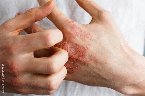 The problem with many people - eczema on hand. White background. Man itchind skin. photo