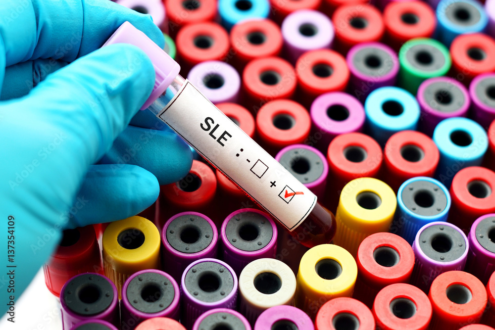 Fototapeta premium Blood sample positive with systemic lupus erythematosus (SLE)
