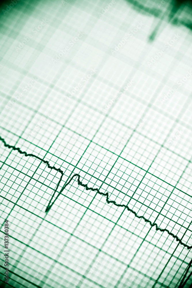 Electrocardiogram Electrocardiogram