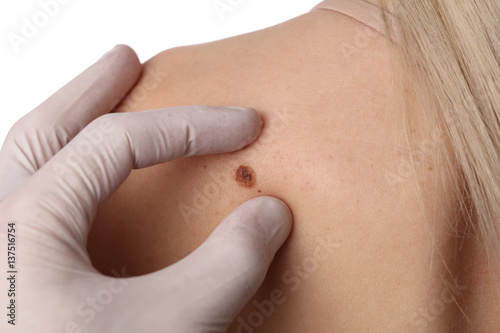 Schilderij op canvas Doctor dermatologist examines birthmark of patient close up isolated on white background