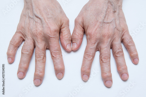 Osteoarthritis Hands and fingers of a female's hands.