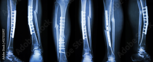 Photography Collection image of leg fracture and surgical treatment by internal fixation with plate and screw