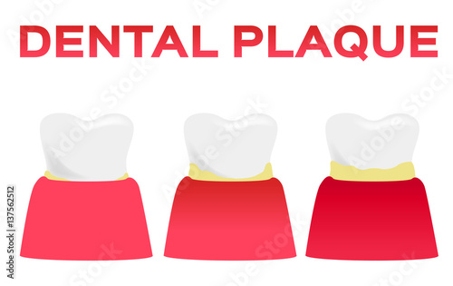 dental plaque vector . tooth and gum