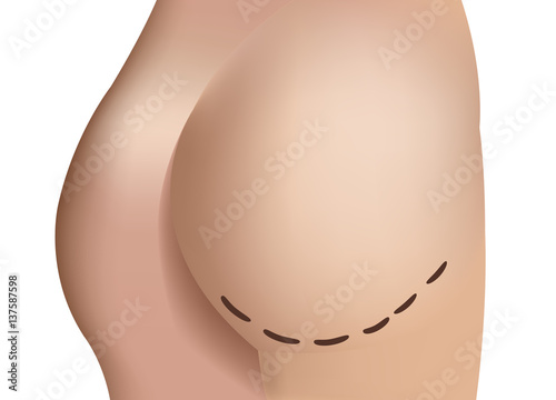 lifting sedere estetica