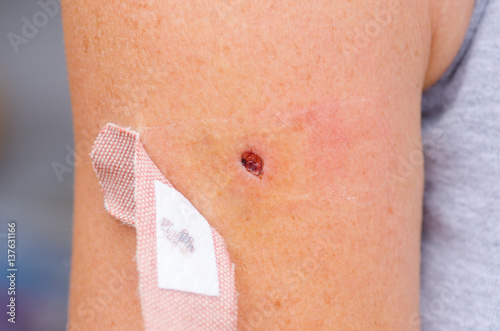 Bloody scab wound and band aid on skin