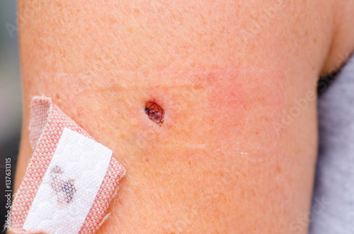 Bloody scab wound and band aid on skin