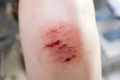 Foto Bruised wound injury on woman knee background