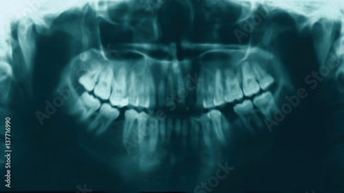 X-ray image of teeth people, stomatology concept