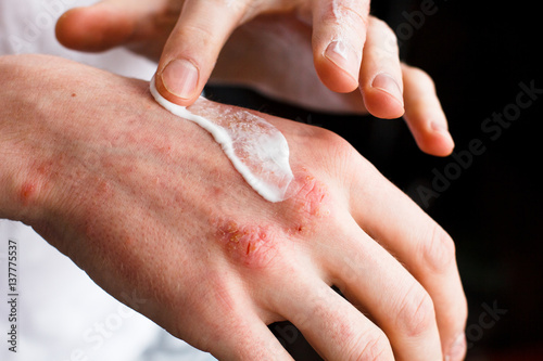 Dermatologist doctor doing treatment, male patient with allergic rash dermatitis eczema skin, Skin diseases. photo