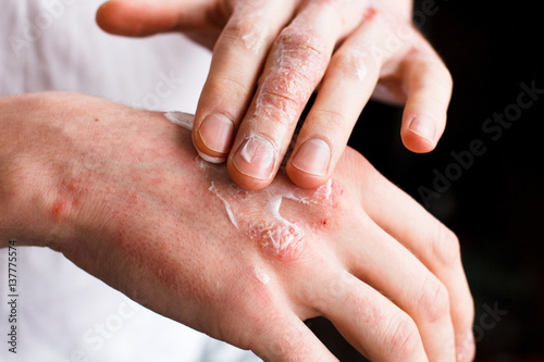 Dermatologist doctor doing treatment, male patient with allergic rash dermatitis eczema skin, Skin diseases. photo