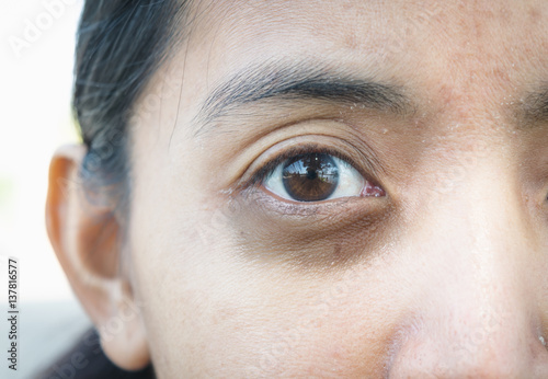Dark circles around eye.