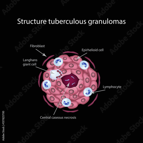 The structure of tuberculous granulomas. Vector illustration