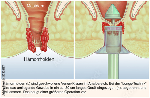 Hämorrhoiden. Longo-Methode