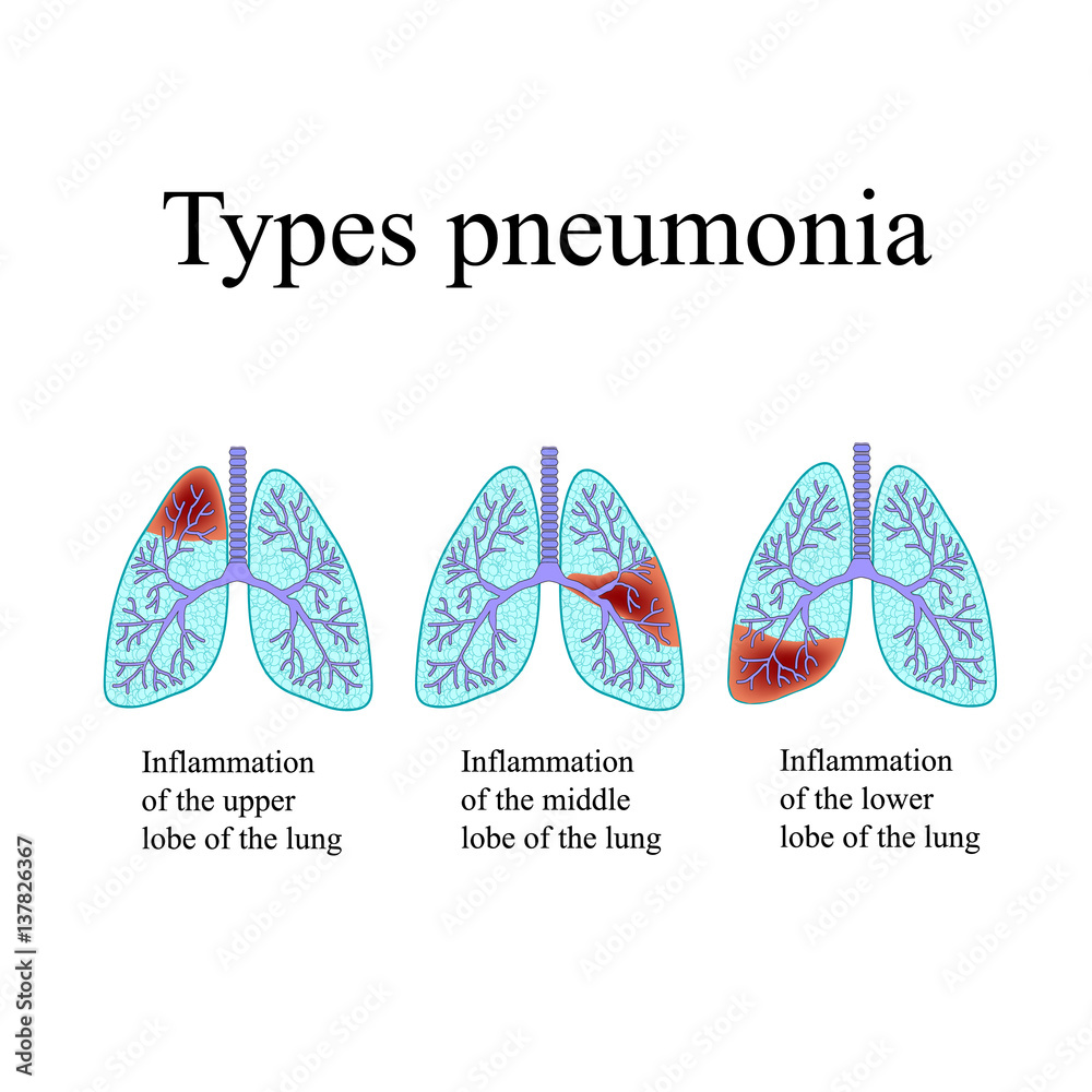 Pneumonia. The anatomical structure of the human lung. Type of ...