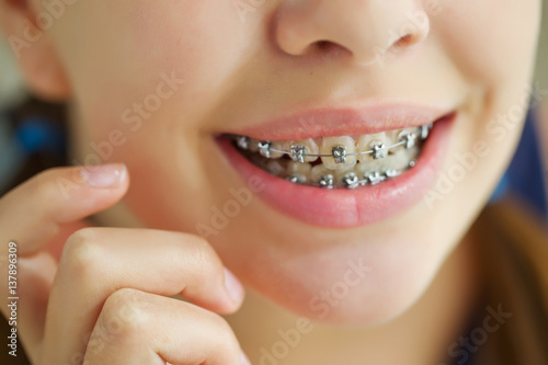 Girl with braces 