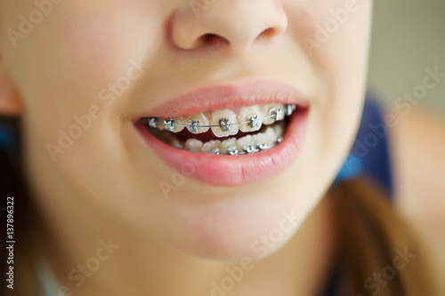 Girl with braces 