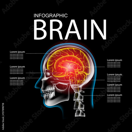 Pain in the Brain, x ray