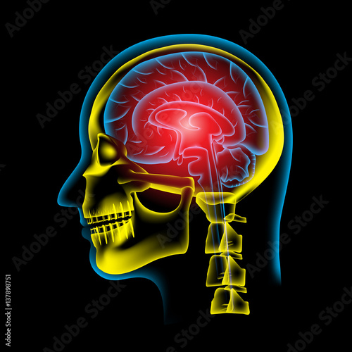 Pain in the Brain, x ray