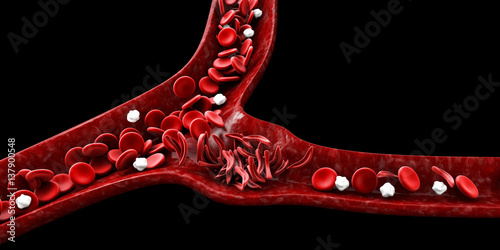 Sickle cell anemia, 3D illustration showing blood vessel with normal and deformed crescent photo