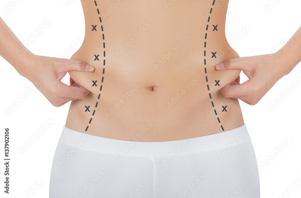 Woman grabbing skin on her flanks with black color crosses marking, Lose weight and liposuction cellulite removal concept, Isolated on white background.