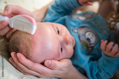 Cradle cap comb removing baby bathe