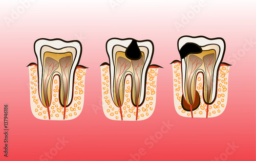 Vector illustration of tooth Decay Caries