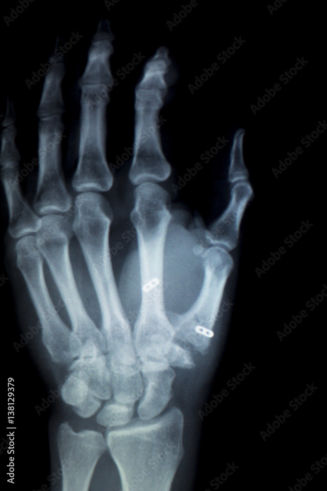 Hand fingers inury Xray scan Hand fingers inury Xray scan