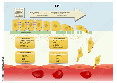 epithelial–mesenchymal transition (EMT): losing cell polarity and cell adhesion to gain migratory and invasive properties.