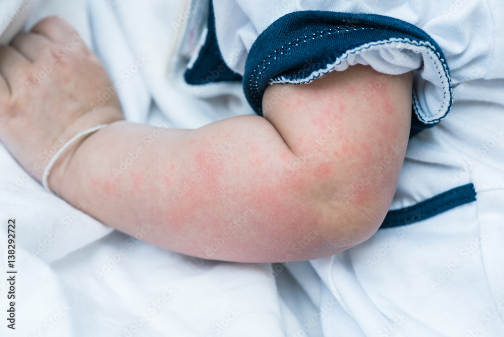 Baby skin texture suffering severe urticaria, nettle rash.