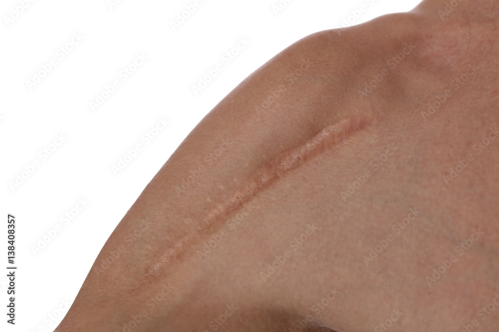 Fototapeta premium Man with scar on his shoulder close up. Laser Scar Reduction concept