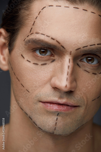 Plastic Surgery. Handsome Man With Lines On Facial Skin