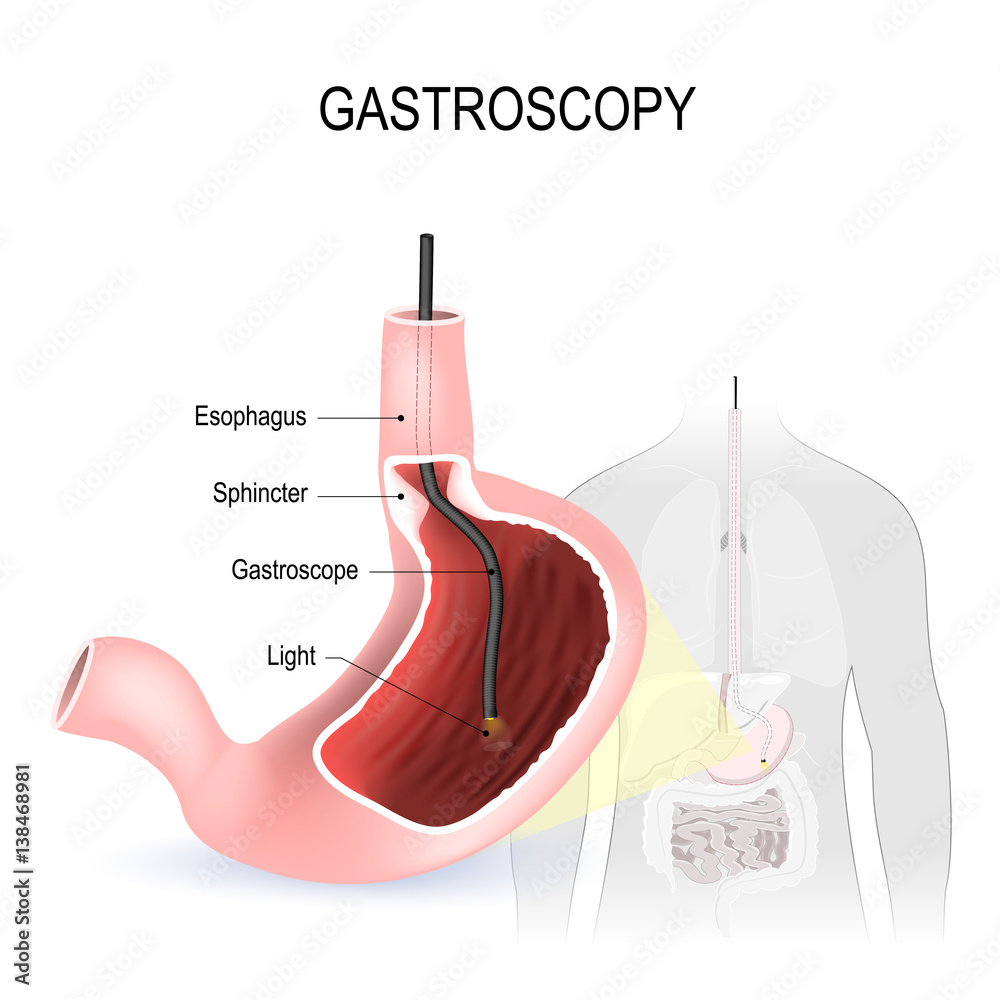 Gastroscopy, Esophagoscopy and duodenoscopy Adobe