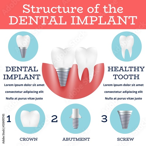 Dental Implant Structure Logo Surgery Dentistry Vector Illustration. Medical Conception for Tooth Clinic.Tooth Implant Clean Enamel on Green Blur Pattern.Implant Crown and Abutment for Dental Clinic