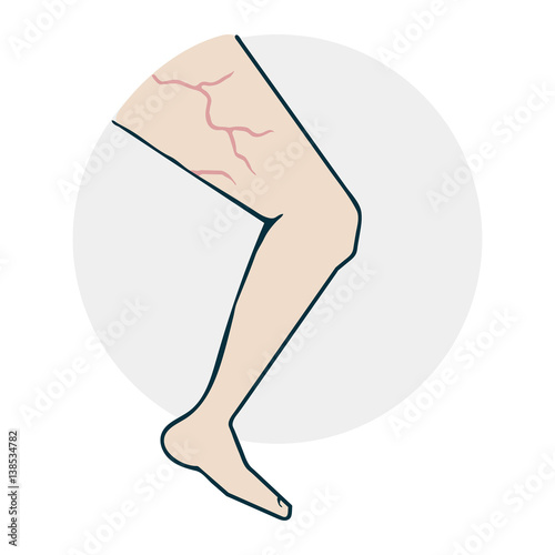 Leg with varicose veins