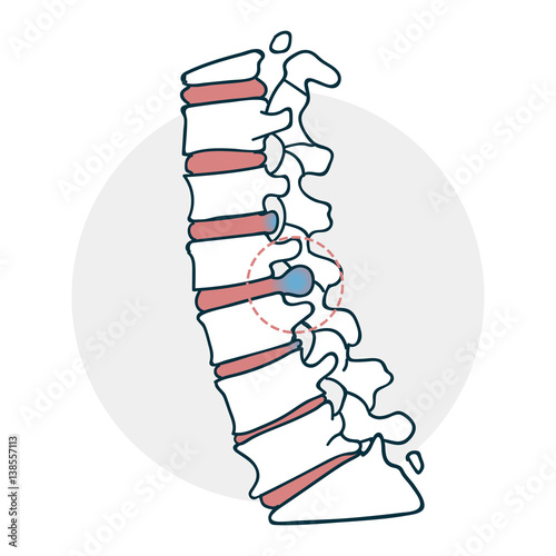 Herniated intervertebral disc icon