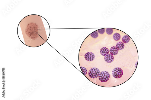 Tableau sur toile Human papillomavirus HPV lesions in men, genital warts, and close-up view of HPV