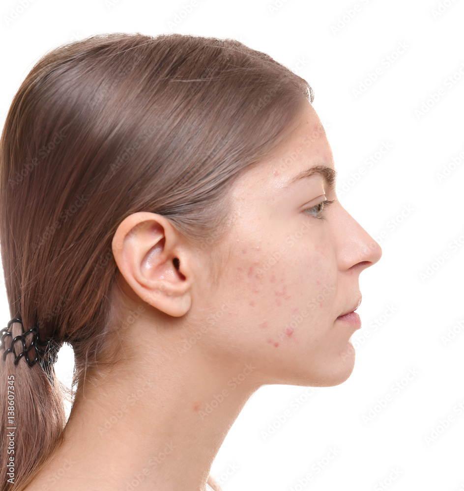 Beautiful young woman with problem skin on white background Beautiful young woman with problem skin on white background