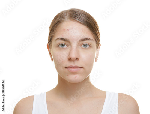 Beautiful young woman with problem skin on white background