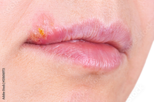 Herpes on the lip close up macro