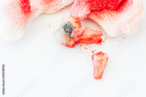 Extraction of decayed tooth with bloody gauze pad on white background. health concept.