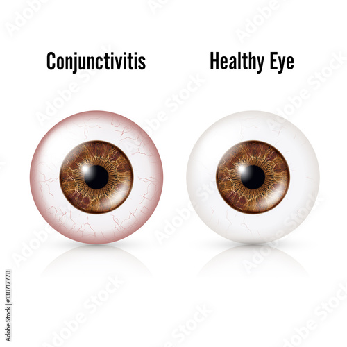 Conjunctivitis. Red Eye. Healthy Eye And Eyeball with Conjunctivitis. Vector Illustration