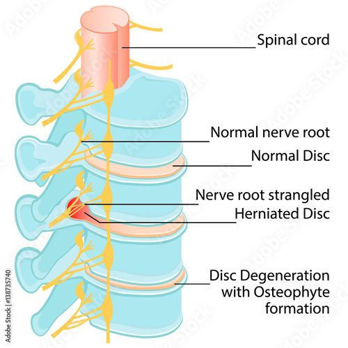 Disc Prolapse Herniation