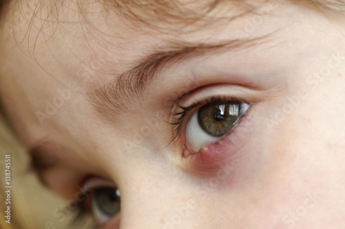Close-up of a child's eye stye. Ophthalmic hordeolum disease